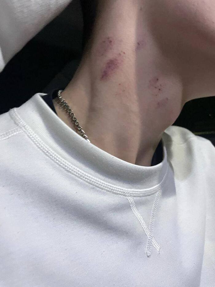 ins love bites images