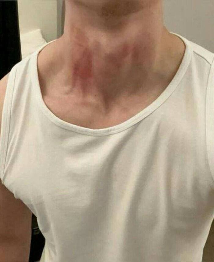 love bites images full size ig