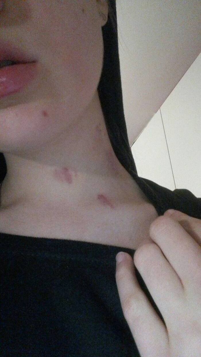 love bites images ig