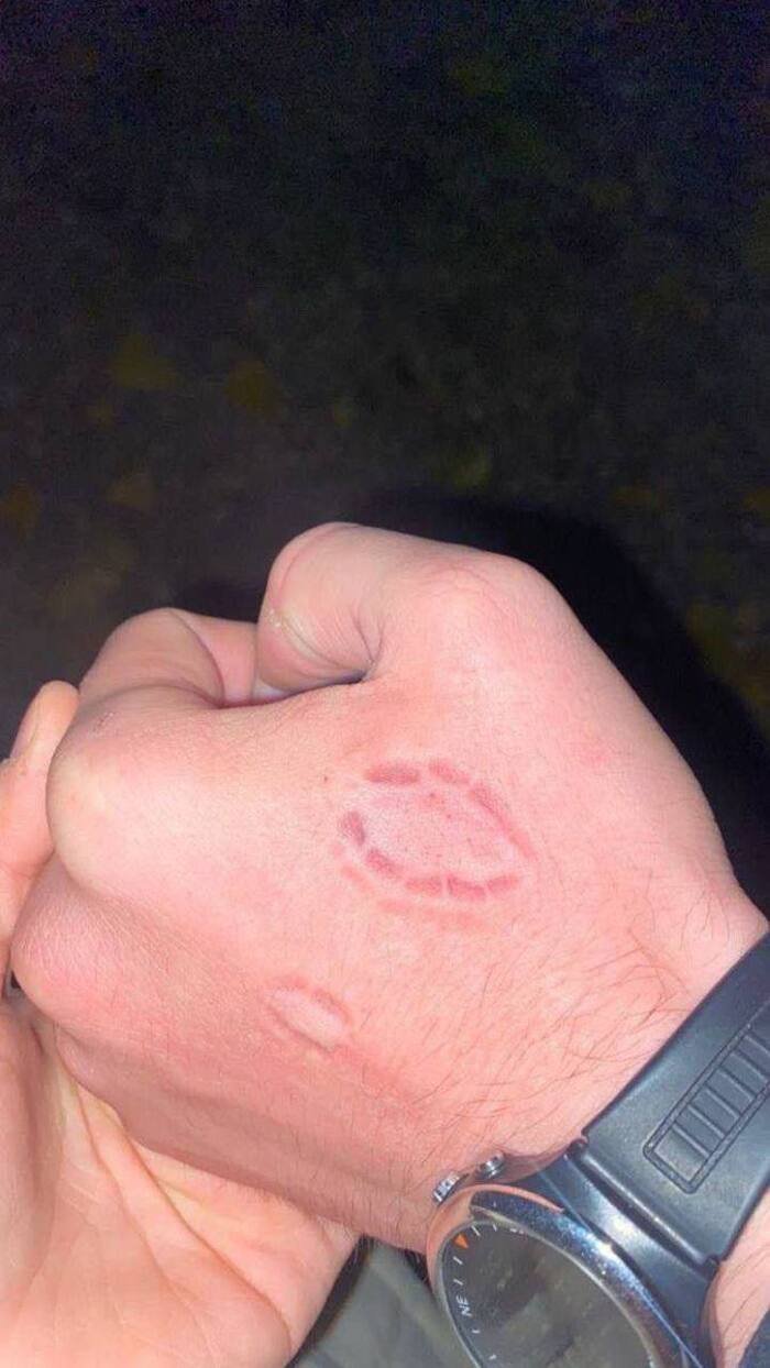 love bites images ins