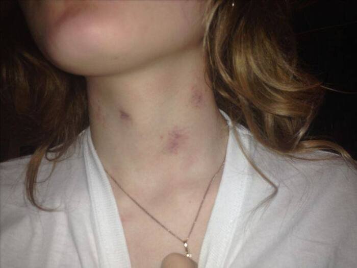 love bites images photo ins