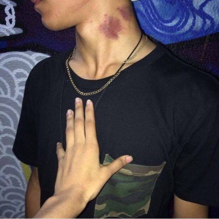 love bites images